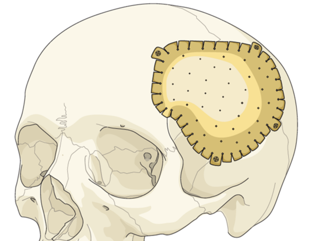 Cranioplasty