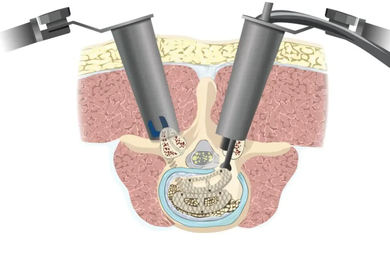 Lumbar Spinal Fusion